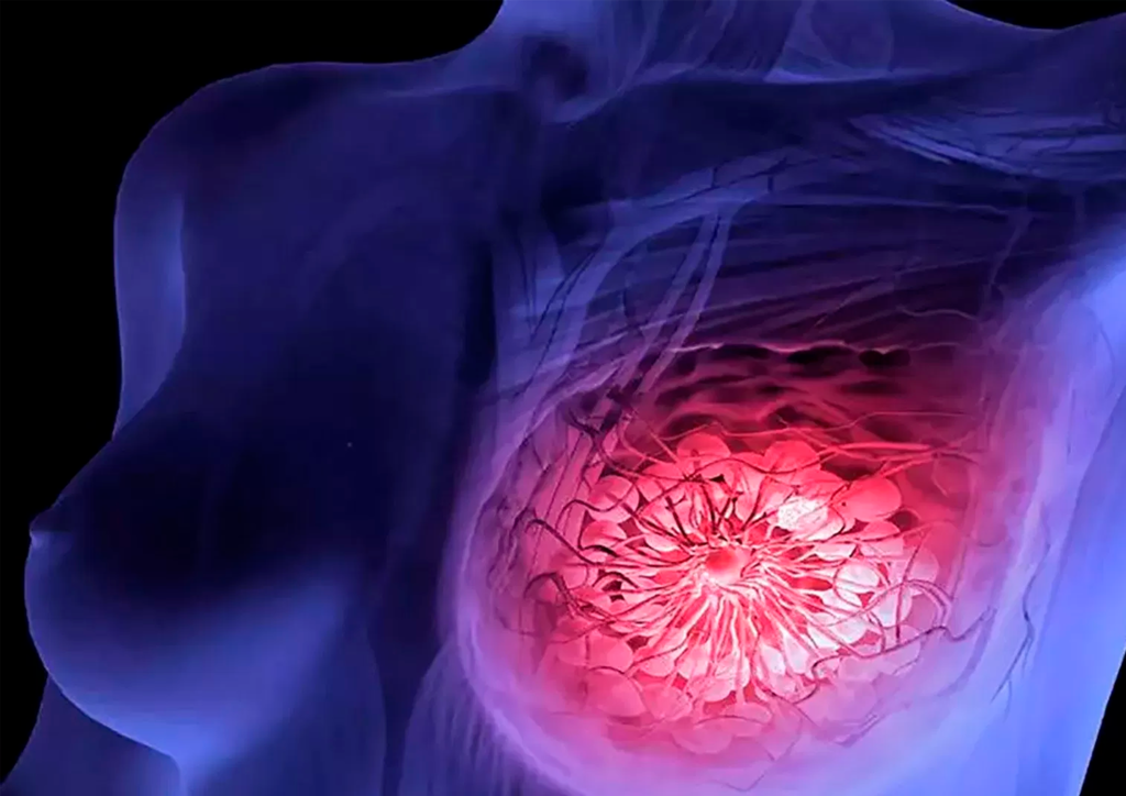 El cáncer de mama puede ser detectado gracias a la Inteligencia Artificial